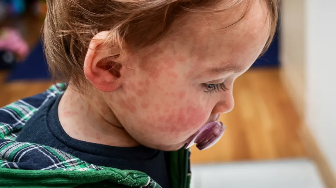 Baby Food Allergies